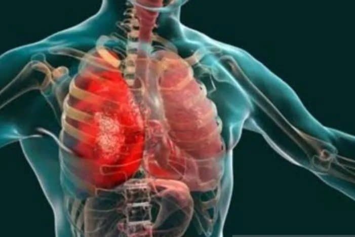 Dari Musim Hujan, Covid-19, Hingga Komorbid Jadi Pemicu Naiknya Kasus Pneumonia - Image