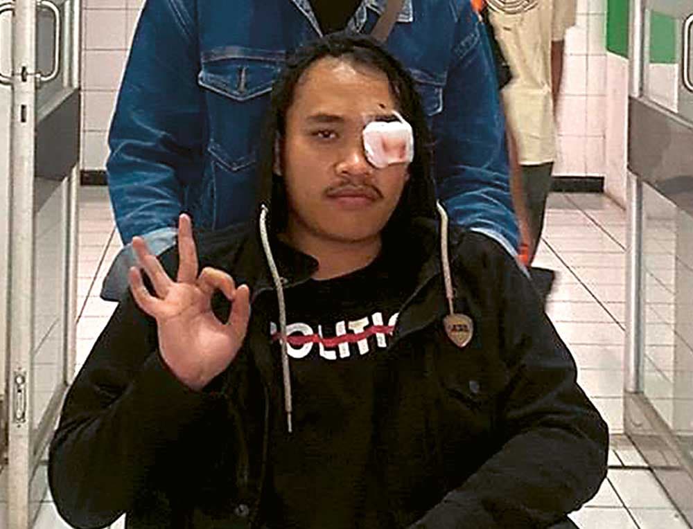 Jadi Korban Demo Tolak Revisi UU Pilkada, Mata Kiri Andi Alami Cedera Serius, Butuh Operasi Lanjutan - Image