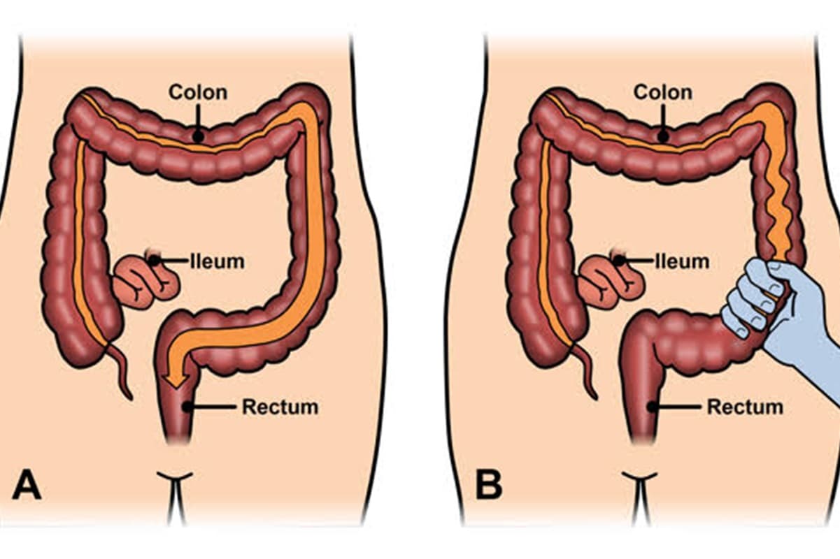 Sering Disepelekan Padahal Berbahaya, Kenali Sebab dan Gejala Penyakit Irritable Bowel Syndrome - Image