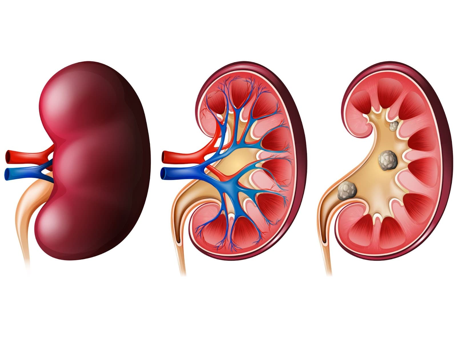 Sudahkah Kita Minum Cukup Air Hari Ini? Ternyata Penyakit Batu Ginjal Umum Terjadi! Ini Hal-Hal untuk Mencegahnya! - Image