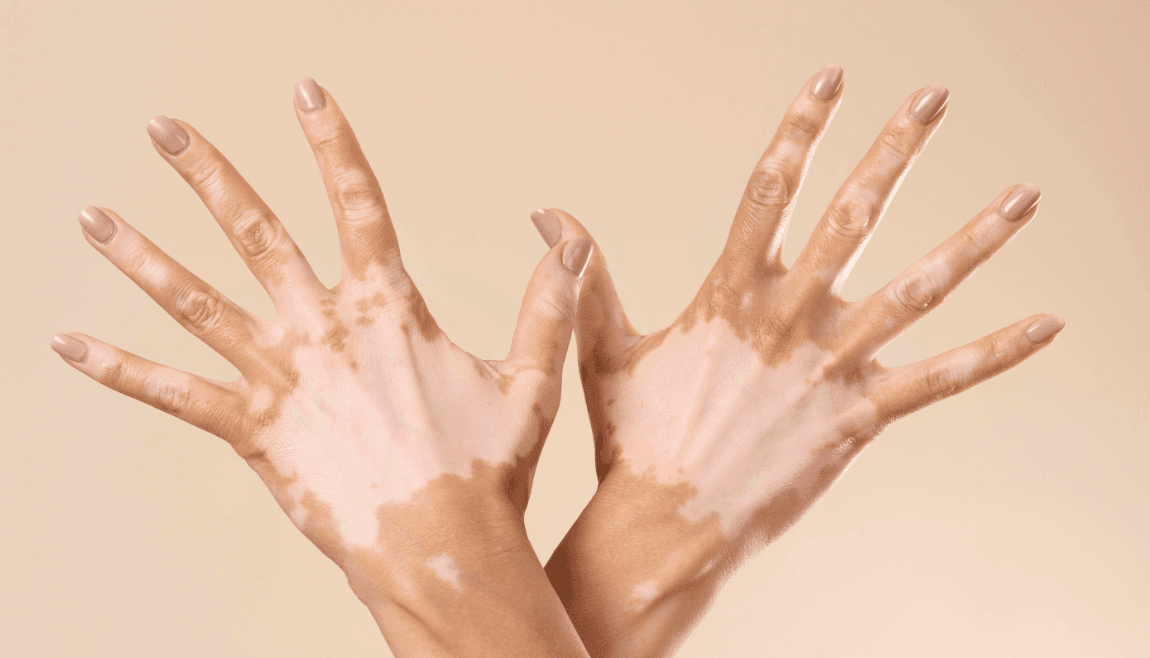 Kenali Vitiligo, Penyakit yang Bikin Warna Kulit Tidak Merata dan Berbagai Pilihan Pengobatan untuk Mengatasinya - Image