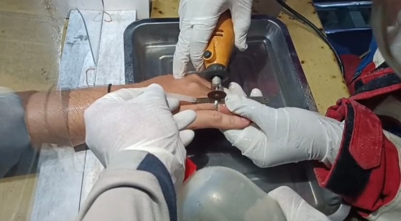 Batal Cantik, Cincin yang Sepekan Terpasang Harus Dilepas Petugas Damkar - Image