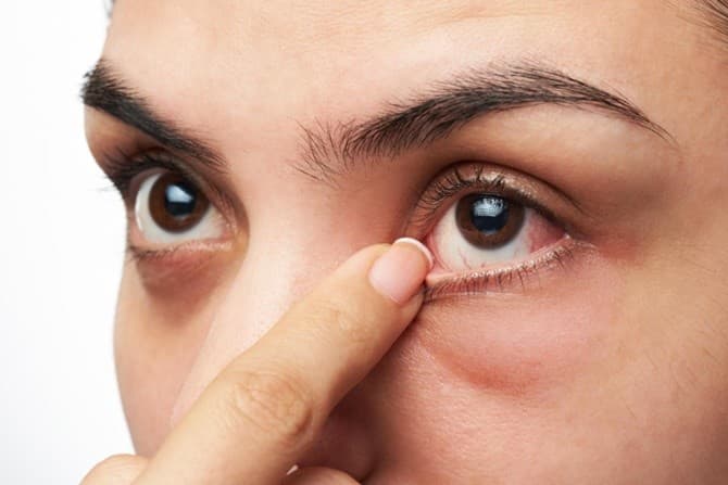 Mata Kering Dominasi Keluhan Pasien, Dokter Soroti Pentingnya Terapi yang Jaga Stabilitas Air Mata - Image